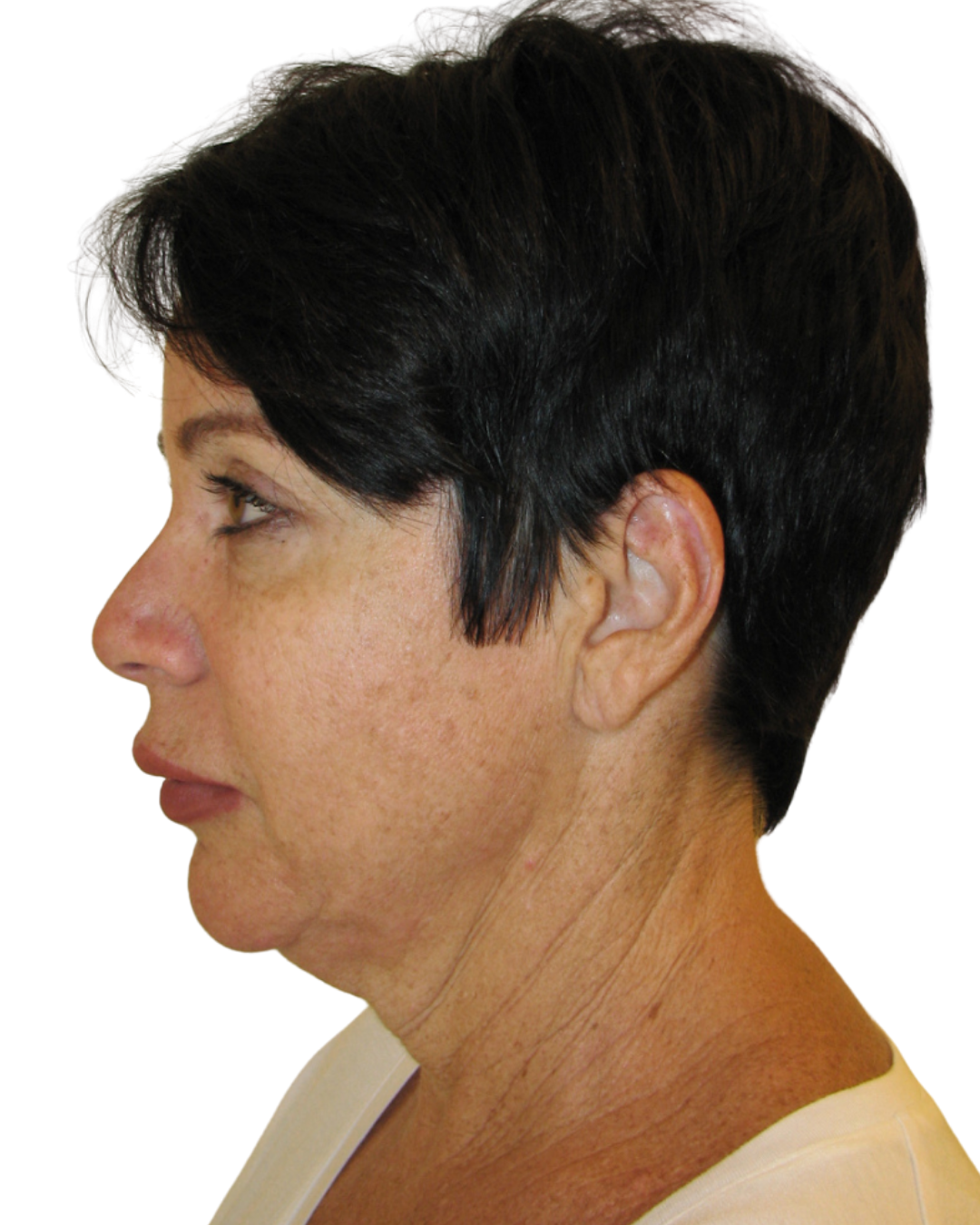 BEFORE FACE + NECKLIFT